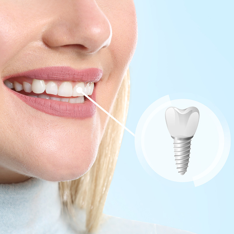 An image of a smiling woman with a toothpaste advertisement overlay, featuring a toothbrush and a close-up of a tooth with a dental implant.